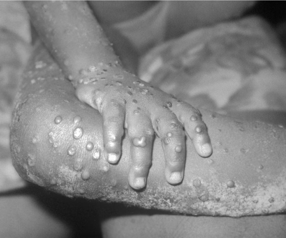 Monkeypox on leg and hand of young girl