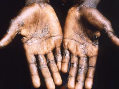 mpox lesions on hands