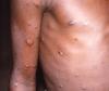 Monkeypox lesions on arm and chest