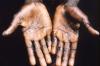 Monkeypox rash on palm of hands