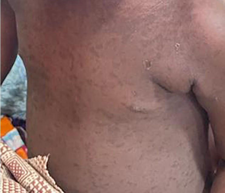 CDC measles photo