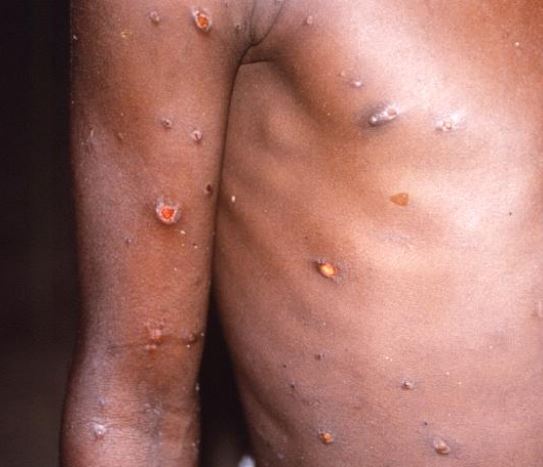 Mpox and arm and chest