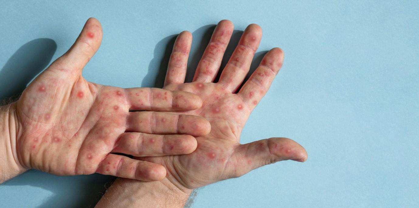 mpox on hands