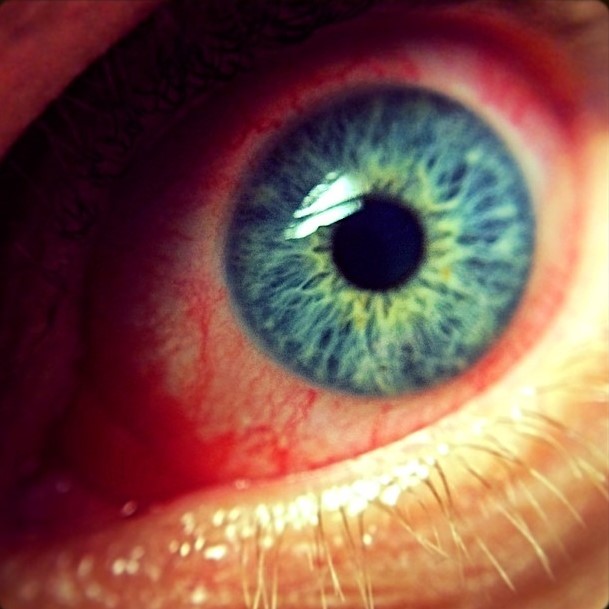 Conjunctivitis