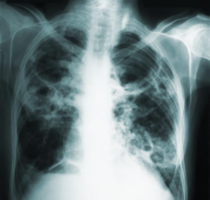 Tuberculosis on chest x-ray