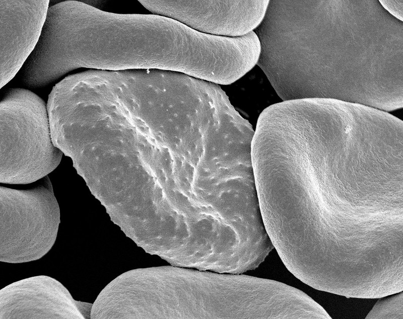 infected RBCs