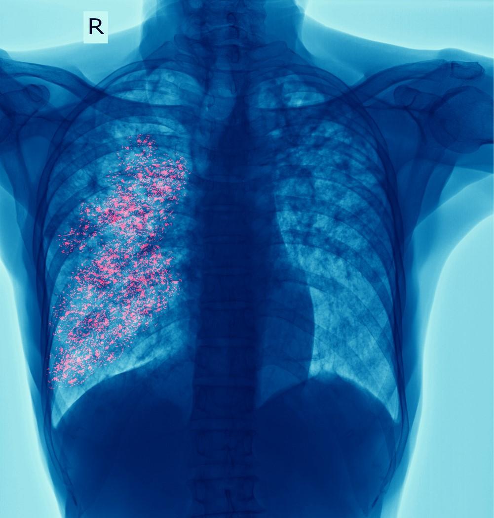 Tuberculosis in red on x-ray