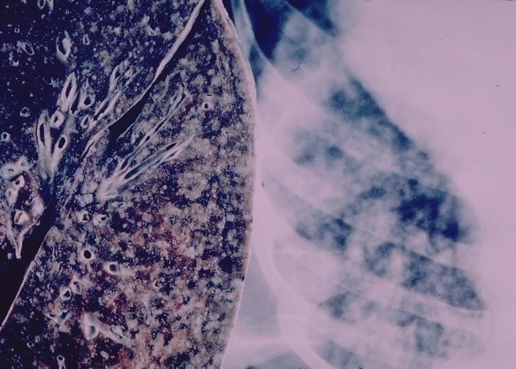 Miliary tuberculosis lung damage