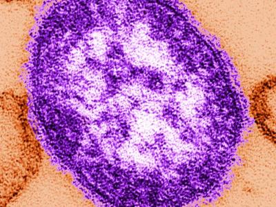 measles image