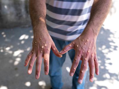 Mpox on back of hands