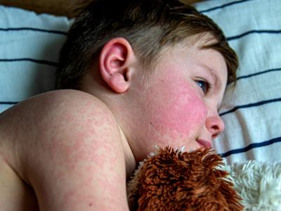 boy with measles