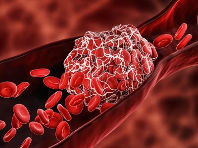 Blood clot blocking blood vessel