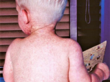 Toddler boy with measles