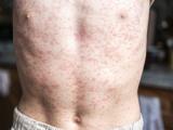 measles torso