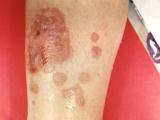tinea