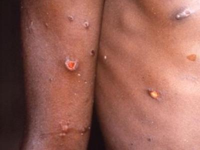 Monkeypox lesions on arm and torso